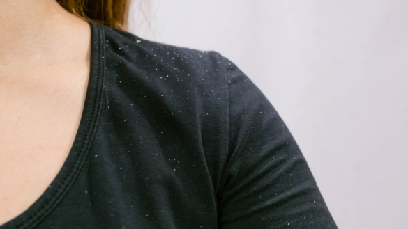 Alt om skæl – årsag, symptomer og behandling af skæl